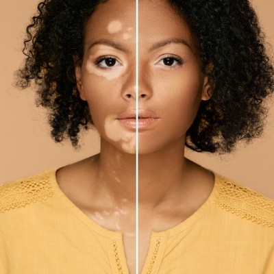 Comment camoufler le vitiligo avec la dermopigmentation ?
